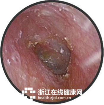 采耳有讲究 爱在洗头店里掏耳 他的耳朵竟发霉