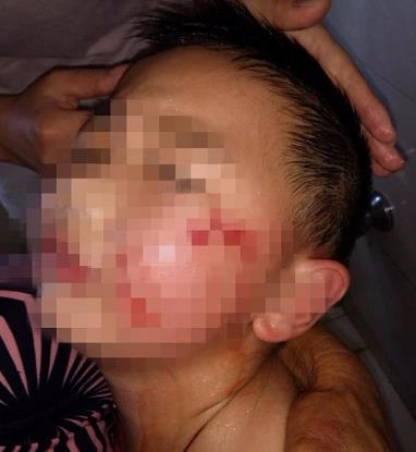 浙江一7岁男孩被邻居家窜出来的狗咬伤 脸部缝了50多针！