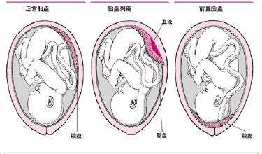 29岁宁波产妇胎盘早剥 医生13分钟急救保母子