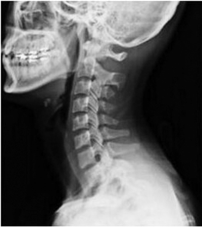 200多例青少年颈椎X光片 过半出现颈椎曲度变直