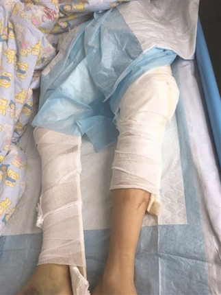 医院腿受伤的照片图片