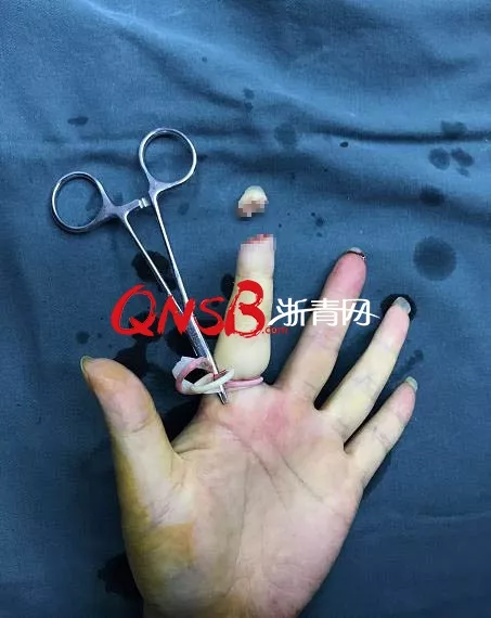 杭州男子被自己养的小狗咬断食指 而且接不回去了